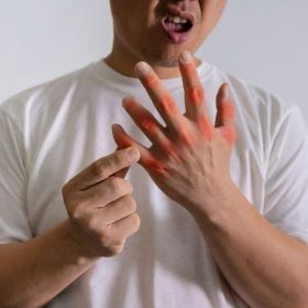 Bệnh gout sau tết tăng cao thường do 3 nguyên nhân này! 3 benh gout